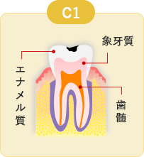 軽度のむし歯