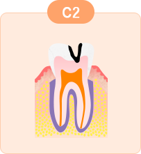 中度のむし歯