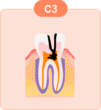 重度のむし歯