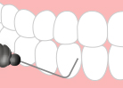 1.歯石の除去