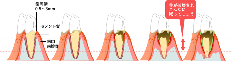 歯周病の進行