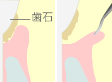 歯周ポケット掻爬術