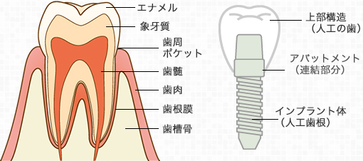 インプラントの構造